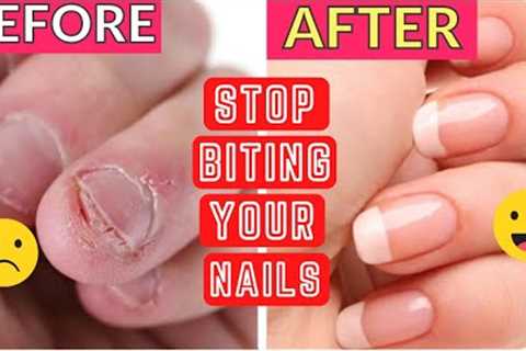 How to Stop Biting Your Nails | Tricks To Quit Nail Biting | Ways to Stop Biting Your Nails! Nail
