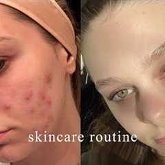 the skincare routine that FINALLY cleared my acne