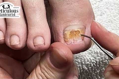 👣 Big Toenail Fix at Home #nails #satisfying