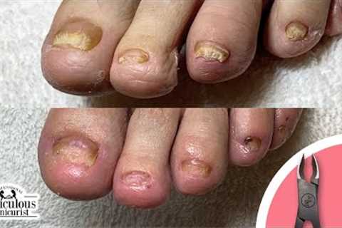 👣Thick Yellow Toenails Before and After #nails #satisfying