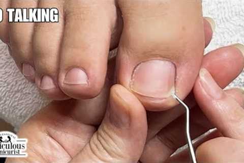 👣 Deep Sidewall Toenail Cleaning - No Talking #nails #satisfying